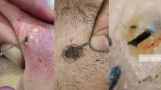 Super Satisfying Ingrown Hair Removal💚Ingrown Hair Removal 2022💚TiKTok Compilation [upl. by Maisie]