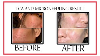 HOW TO TREAT ACNE SCARS TCA CROSS  TCA PEEL  MICRONEEDLING RESULT  BEFORE AND AFTER PICTURES [upl. by Truda]