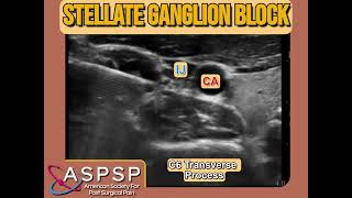 Ultrasound Guided Stellate Ganglion Block [upl. by Molohs]