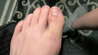 Broken Toe part 2  Weird Wednesday [upl. by Aihsenek]