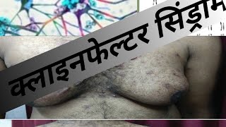 klinefelter syndrome  klinefelter syndrome in hindi class 12 biology  क्लाइनफेल्टर सिंड्रोम [upl. by Gnanmas]