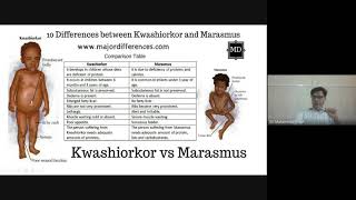 Kwashiorkor and Marasmus What’s the Difference [upl. by Ethe294]