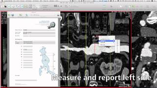 AAA Sizing with aycan OsiriX PRO [upl. by Adniram]