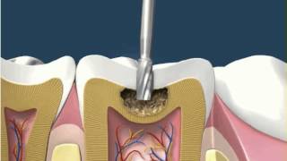 Dental Fillings White Amalgam 1 [upl. by Bastian]