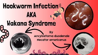 Hookworm Causes Signs and Symptoms Diagnosis and Treatment  Intestinal Nematodes  Novice Medic [upl. by Suilenrac]