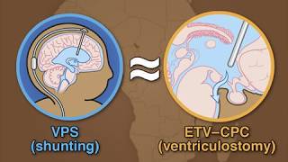 Treatment for Postinfectious Hydrocephalus in Infants [upl. by Downing523]