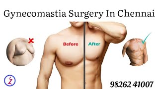 Gynecomastia Surgery In Chennai  Gynecomastia Surgery Cost In Chennai  Zenith Clinic [upl. by Ainnos]