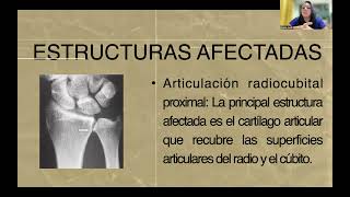 OSTEOARTRITIS DE LA ARTICULACION RADIOCUBITAL Y PROXIMAL [upl. by Iana12]