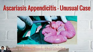 Unusaul Case of Ascariasis Appendicitis  Surgeon Dr Imtiaz Hussain [upl. by Nossaj]