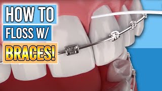 FLOSSING WITH BRACES 3 Tools to Make Flossing With Braces Easy [upl. by Aron]