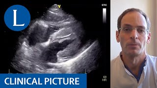 Myocarditis in a patient with COVID19 [upl. by Bryce]