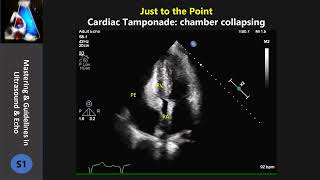 cardiac tamponadecollapsing chamber [upl. by Candide]