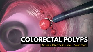 Colorectal Polyps Causes Signs and Symptoms Diagnosis and Treatment [upl. by Aicilla]