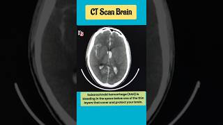 Subarachnoid hemorrhage SAH mri brain radiology shorts [upl. by Grissom626]