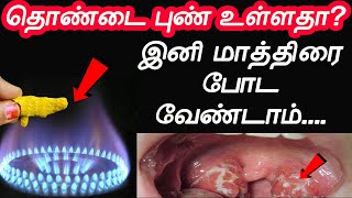 என் பாட்டி கை வைத்தியத்தால் எனக்கு சரியானது  thondai pun maruthuvam  Throat Pain  thondai vali [upl. by Ecnatsnoc]