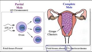 Video 254 Hydatidiform Mole Molar Pregnancy Partial vs Complete Mole amp Associated Risk Factors [upl. by Spevek]