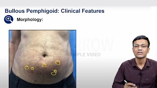 E6 Sample Video Pemphigoid Group of Bullous Disorders Dermatology [upl. by Zina973]