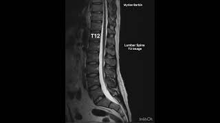 MRI Lumbar Spine anatomy diagnosticradiology mri [upl. by Tav]