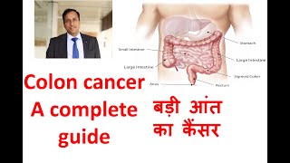 Colon cancer in Hindi Large Bowel large intestine cancer Symptoms treatment Dr Vikas Singla [upl. by Nennarb]