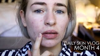 Roaccutane Daily Skin Vlog  Month 4 [upl. by Oirtemed]