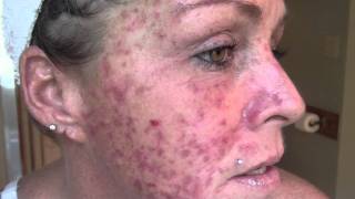 Skin Cancer My VlogJournal Treatment W EFUDEX vid9 [upl. by Honoria]