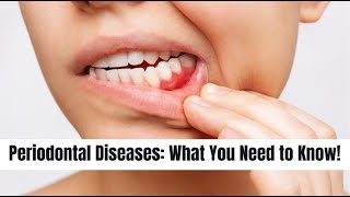 Periodontal Diseases What You Need to Know  Mind Musings dentistry dentaldisease oralhealth [upl. by Losyram]