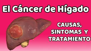 CÁNCER DE HÍGADO Causas signos y síntomas diagnóstico y tratamiento [upl. by Lleruj]