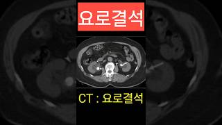 요로결석 CT 진단 결석 요관 ureter stone [upl. by Nicolle]