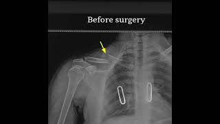 Clavicle Fracture Xray Before After Surgery [upl. by Wendt]