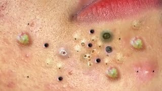 Blackheads amp Acne Treatment Latest Update 97 [upl. by Brandt]