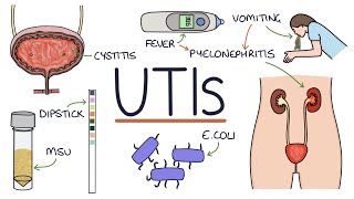 Understanding Urinary Tract Infections [upl. by Allecsirp]