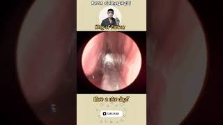 귀지형 콧물 부비동염 축농증 비염 코청소 이비인후과 rhinorrhea rhinitis sinusitis asmr ENT entdoctor [upl. by Anneuq]