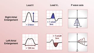 Intro to EKG Interpretation  Chamber Enlargement [upl. by Hatnamas]