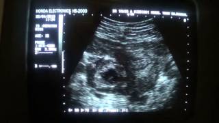 complicated RT adnexal CYSTIC MASS with FLUID [upl. by Dazraf601]