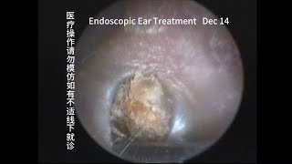 Blackhead cleaning in the external ear canal 20231214 [upl. by Callas]