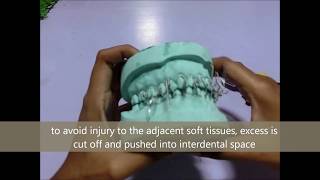 Interdental Wiring and Intermaxillary Fixation [upl. by Acila890]