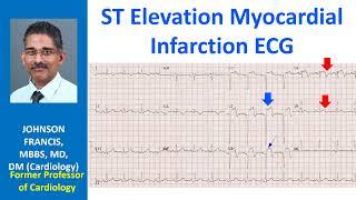 ST Elevation Myocardial Infarction ECG [upl. by Yvon]