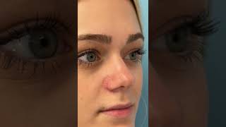 NOSE JOB TIPPLASTY BEFORE AND AFTER  DR TANVEER JANJUA NEW JERSEY [upl. by Esiole]