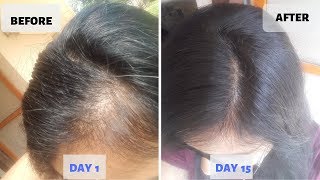 OMG  15 Days Hair Growth Miracle Treatment  Grow Long Thicken Hair  100 works [upl. by Bard]