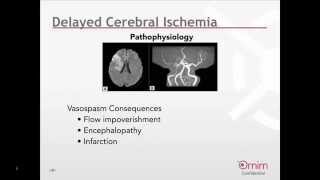 Monitoring for Delayed Cerebral Ischemia following Subarachnoid Hemorrhage Webinar English [upl. by Annavaig]