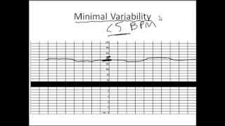 NonStress Test Made Simple [upl. by Aneeram]