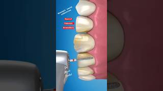 Dental Veneers Procedure [upl. by Anoyk]