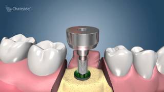 Dental Implant Procedure  Two Stage 🦷 Award Winning Patient Education [upl. by Florry721]