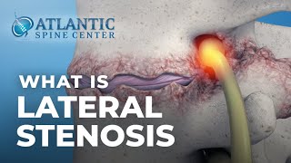 What Is Lumbar Lateral Stenosis  Foraminal Stenosis [upl. by Atsirhcal]