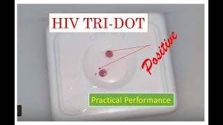 HIV Rapid antibody testReactive HIV tridot Positive HIV blood test Positive [upl. by Nilahs]