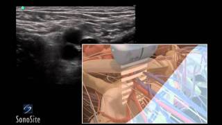 How To Ultrasound Guided Insertion of a Femoral Vein Catheter 3D Video [upl. by Mchugh]