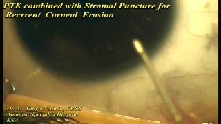 PTK with stromal Puncture for RCE [upl. by Gaskin646]