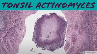 Tonsil Actinomyces 5Minute Pathology Pearls [upl. by Katrine]