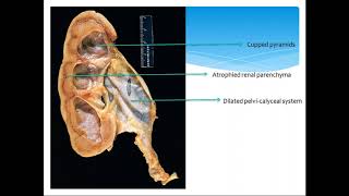 A Class On HYDRONEPHROSIS Or OBSTRUCTIVE UROPATHY By Dr Sarvani Dept Of Pathology [upl. by Diandra]