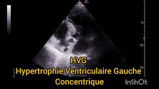 HVG Hypertrophie Ventriculaire Gauche Concentrique Échographie [upl. by Tullus]